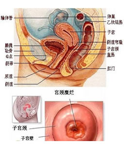 宮頸疾病圖片介紹